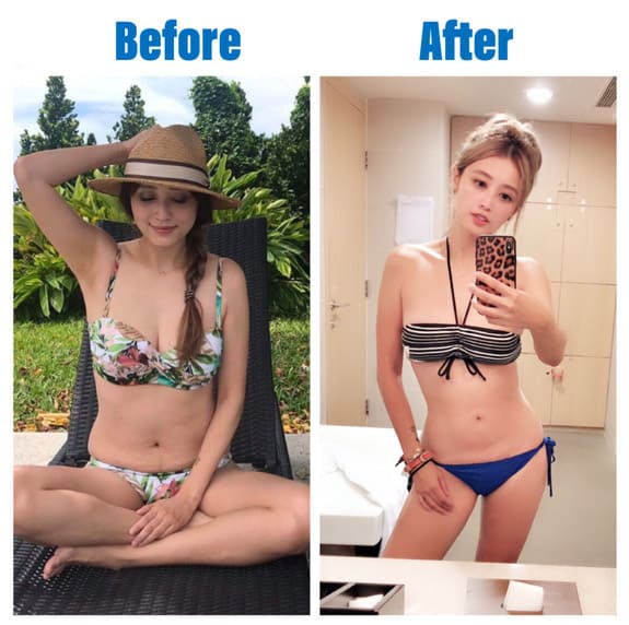 威塑抽脂改善腰部及大腿脂肪,威塑抽脂,大腿抽脂,大腿環抽,李岳樺醫師,博恩妍
